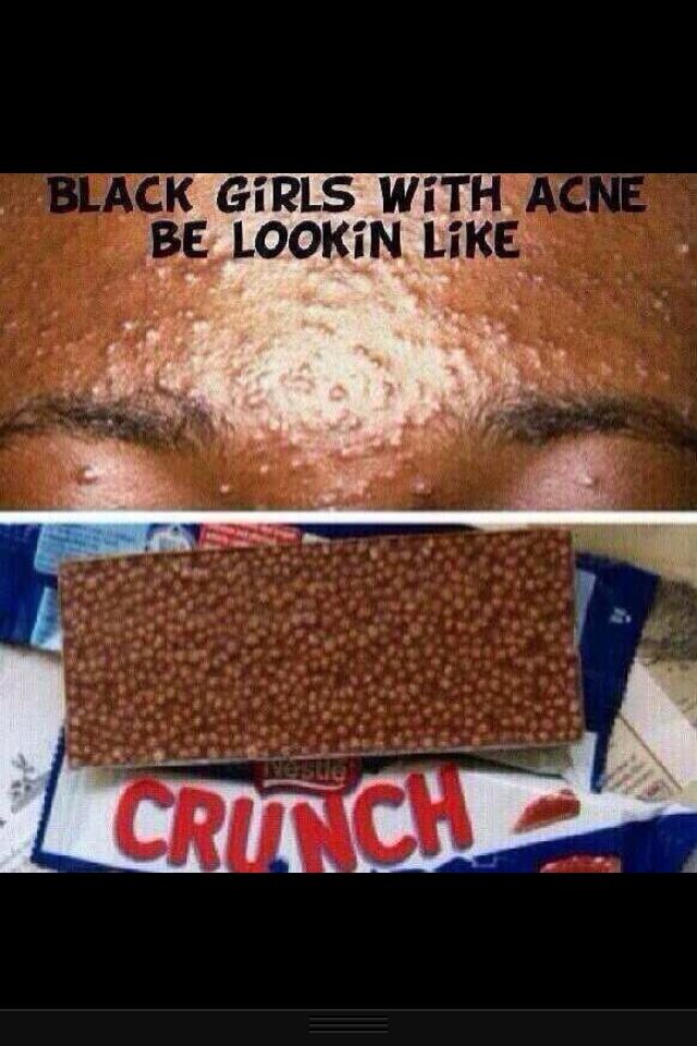 Acne Quotes Funny. QuotesGram