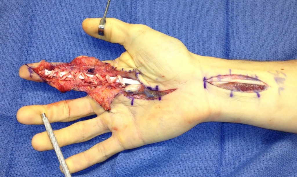 broken thumb with tendon damage photo of woman with small breast