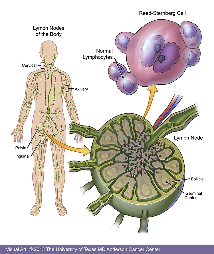 Злокачественными новообразованиями лимфоидной. Лимфоциты в лимфатическом узле. Клетки лимфатического узла. Лимфосаркомы Ходжкина. Лимфосаркома патанатомия.