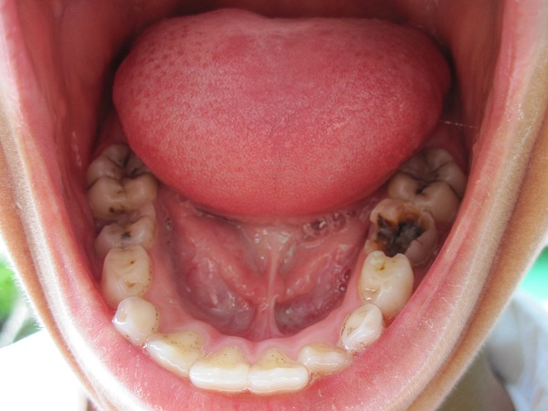 Bad Teeth Quotes. QuotesGram