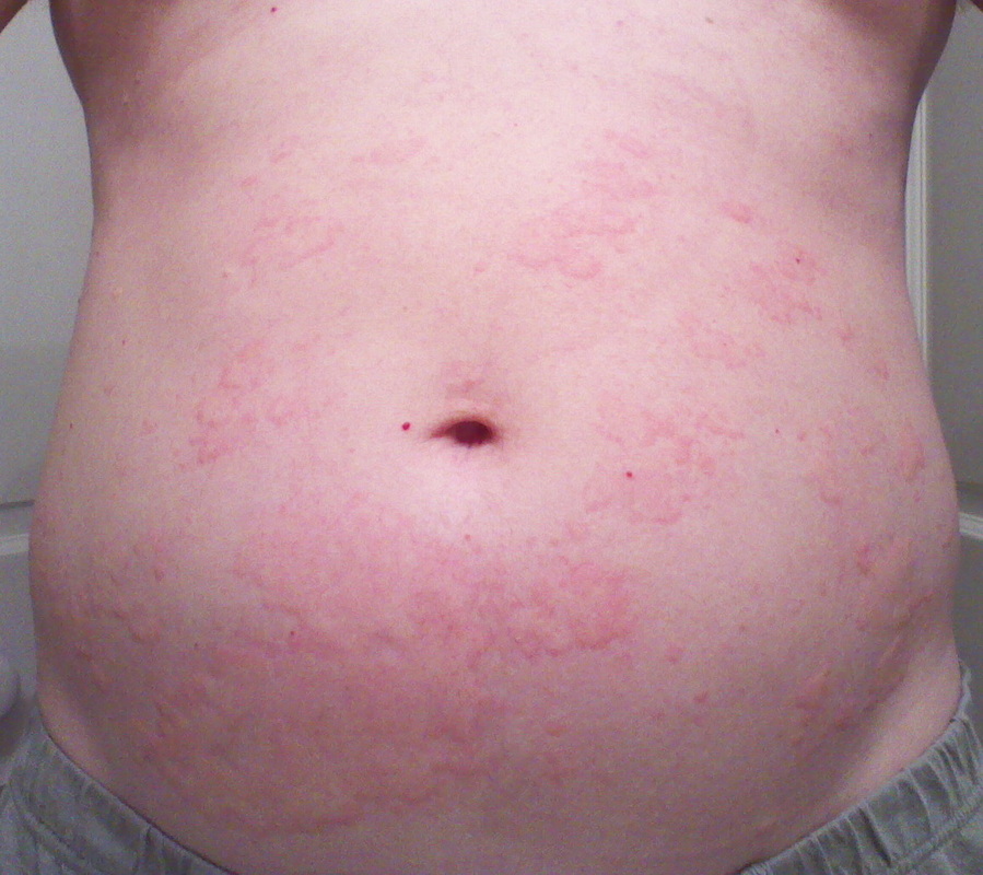 rash from laundry detergent rash from laundry detergent