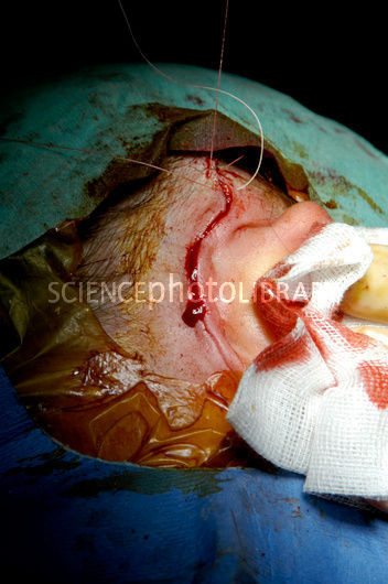 Surgery Hearing Quotes. QuotesGram