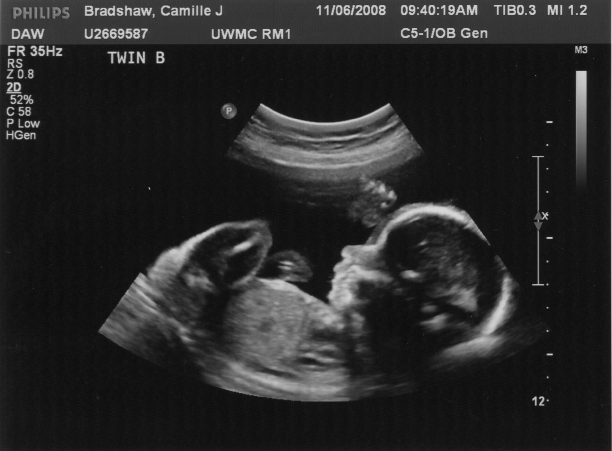 Ultrasound Pictures 75