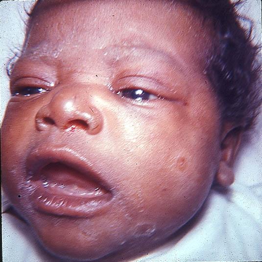 saddle nose syphilis baby