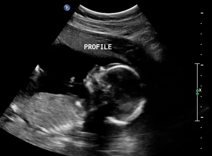 Как выглядеть беременности 19 недель