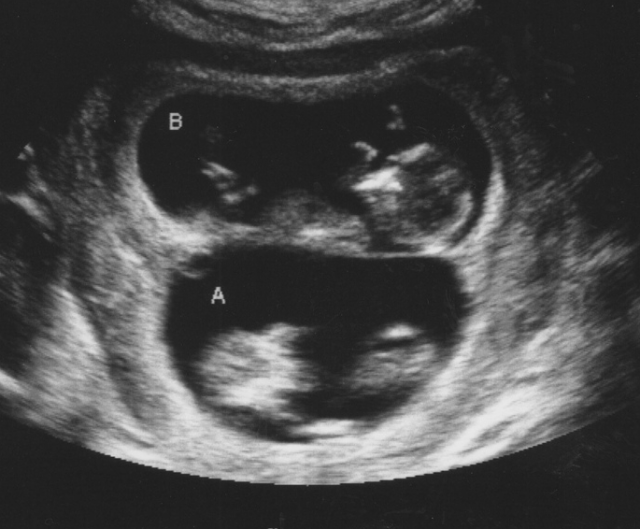 Близнецы 11 недель. УЗИ 13 недель беременности двойня. УЗИ близнецов на 12 неделе беременности. УЗИ 12 недель беременности двойня. УЗИ 11 недель беременности двойня.