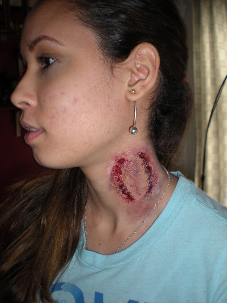 Marks neck bite Bed bug
