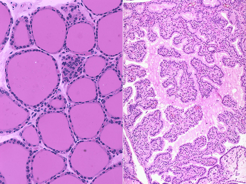 Диффузный препарат. Тиреоидит зоб гистология. Карцинома желудка гистология. Щитовидная железа микропрепарат гистология. Диффузный препарат.