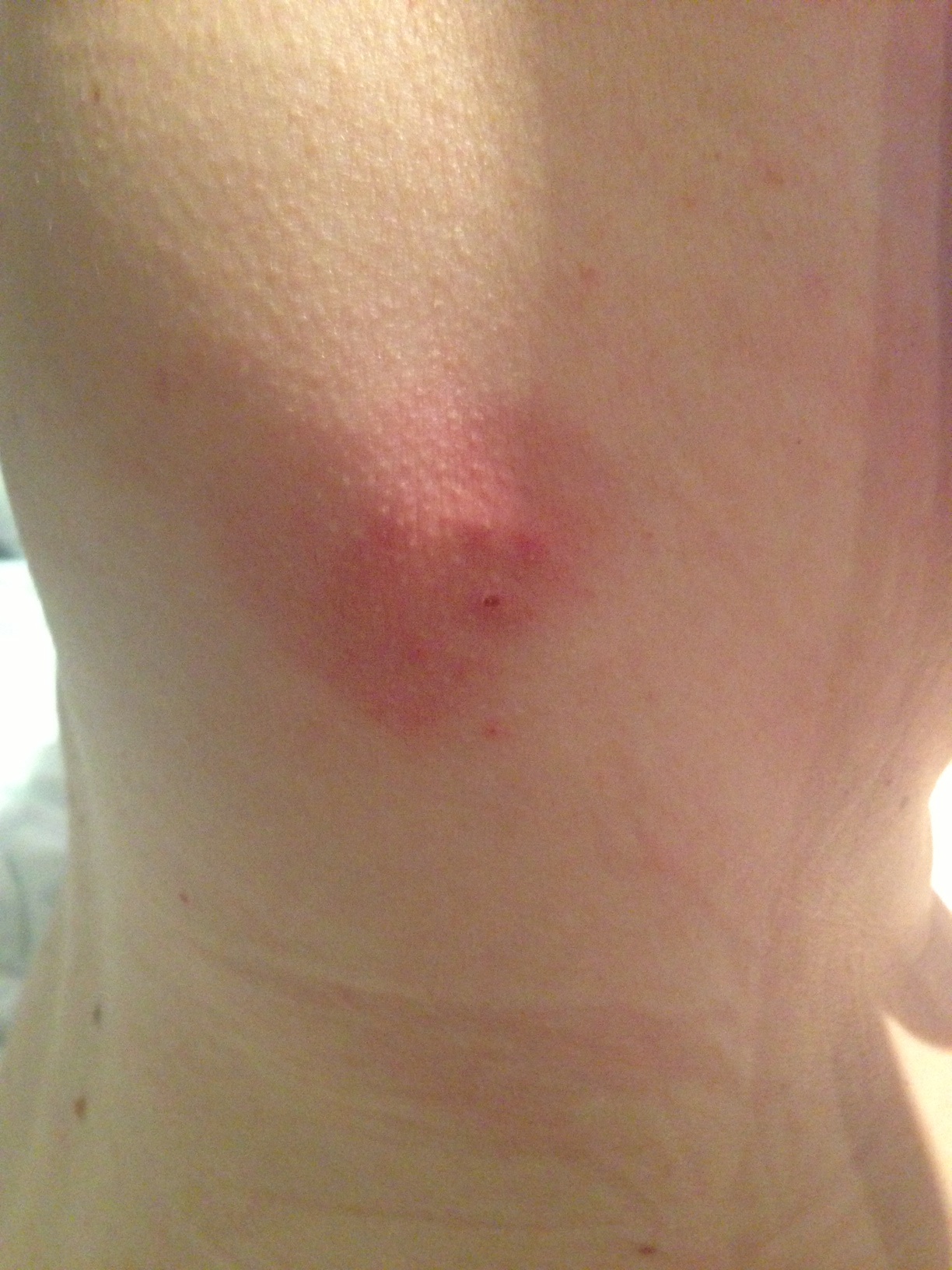 Can Anyone Help Identify These Bites The One In The Middle 45 OFF Can Anyone Help Identify These Bites The One In The Middle 45 OFF