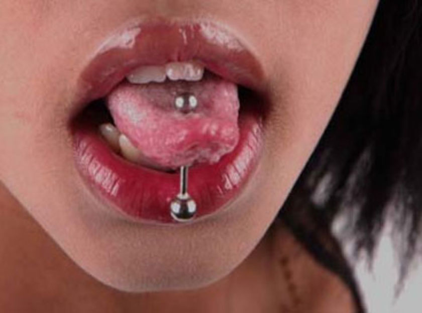 Infección de piercing en la lengua