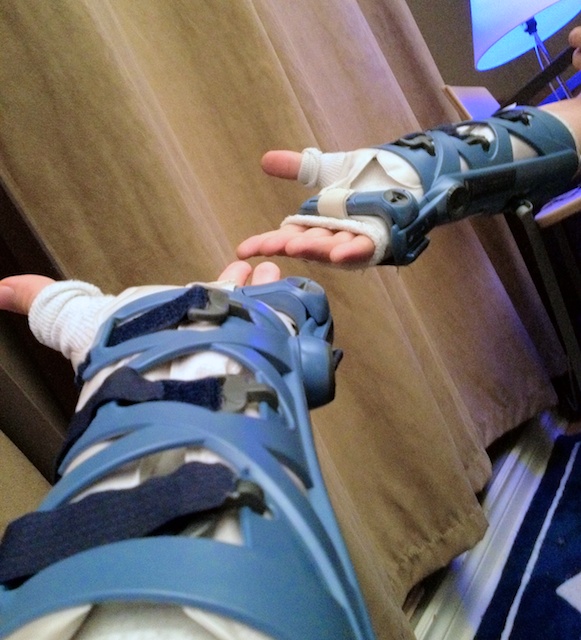 Arm Cast Quotes. QuotesGram