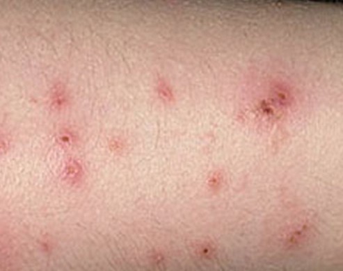 Bug Bite Quotes. QuotesGram