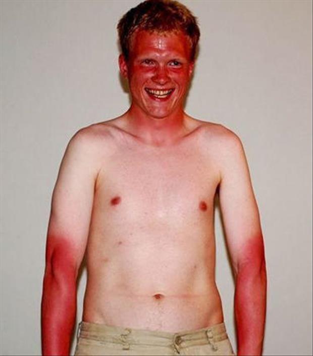 Sun burn quotes quotesgram