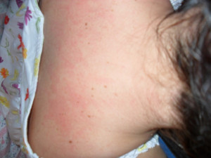 Malar Rash On Back