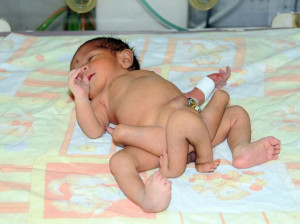 Bebê nasce com 6 pernas no Paquistão