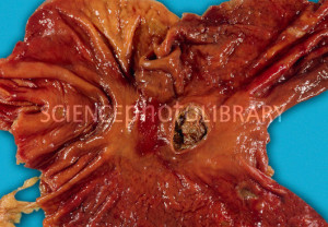 Perforated Stomach Ulcer
