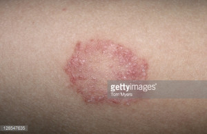 Ringworm and Skin Fungal Infections