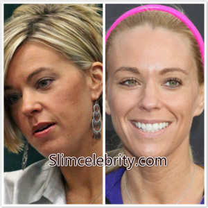 ... Surgery-Before-and-After-Photos-Face-Lift-Botox-Nose-Job-Neck-Surgery