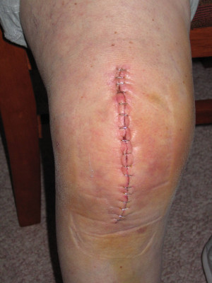 Description Knee Replacement.jpg