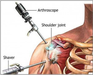Shoulder Impingement Syndrome Surgery