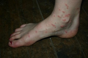 Insect Bite Symptoms And