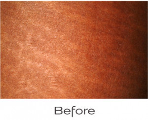 Homemade Stretch Mark Lotion