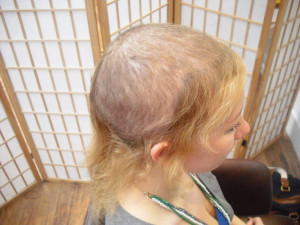 Physical Effects of Trichotillomania