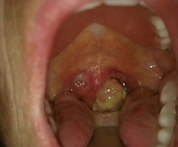 Throat Cancer Pictures Survival...