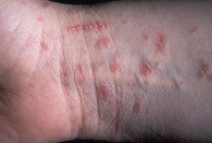 Scabies Symptoms