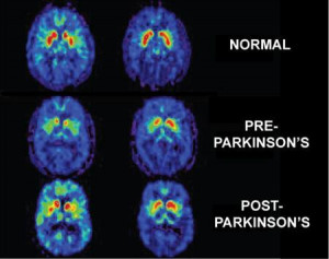 Brain imaging showing the stages of Parkinson's disease. REUTERS/NIH