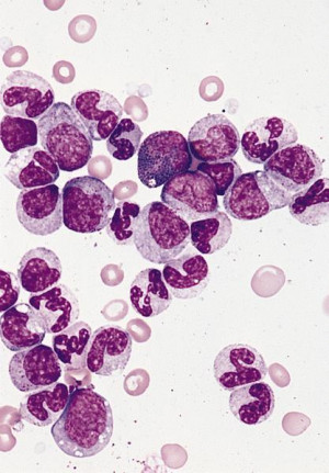 normal vs abnormal bone marrow