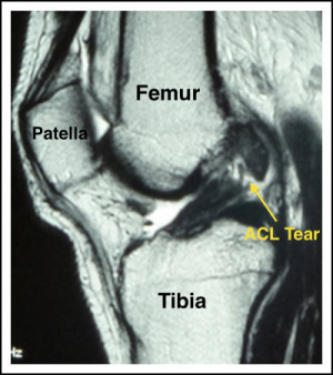 ACL Tear On MRI