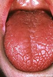 Syndrome? Sicca Sydrome Treatment Sicca Syndrome (Sjogren syndrome ...