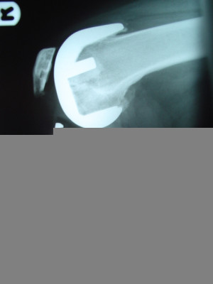 Figure 2B. Post op LAT xray following Total Knee replacement