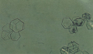 Leucine Crystals in Urine Sediment