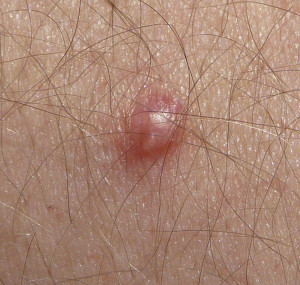 How To Get Rid of Warts on Hands Naturally