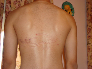 ... be tracking the colour and depth of these stretch marks on my back