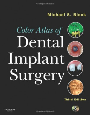 dental implant quotes