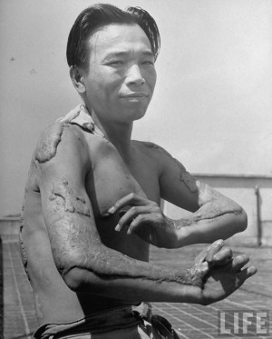 survivor still hospitalized in Hiroshima, showing arms and torso ...