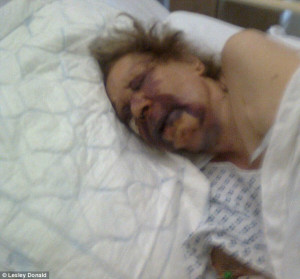 Broken Ribs Bruising Woman 11 fractured ribs and