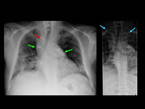 of the thorax showing subcarinal and bilateral hilar lymphadenopathy