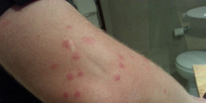 Mosquito Bite Pictures Bed Bug
