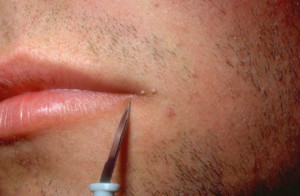 Facial Warts – How To get Rid of Them Fast