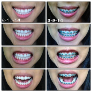 March 14 marks my official 1 month living with braces but these ...