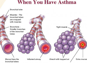 how do you get asthma bronchial asthma causes