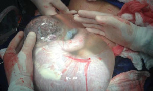 Newborn Baby Delivered Floating in Intact Amniotic Sac, En Caul, by ...