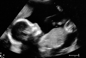 Week Ultrasound Image Baby...