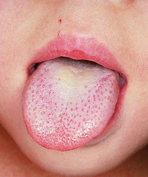 white tongue coating & preventing colds
