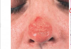 Rheumatic Diseases Of Childhood Discoid Lupus Skin Lesions Face