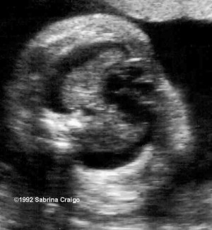 Fetal Pleural Effusion Ultrasound